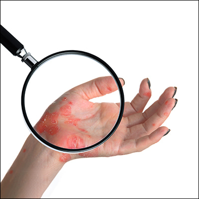 Rischio chimico e danni alla pelle sul luogo di lavoro
